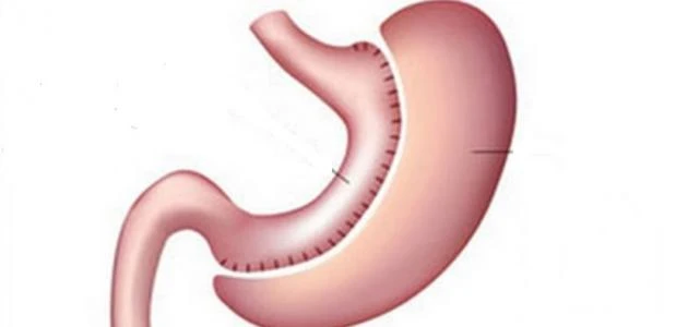 كيف أصغر معدتي بدون عملية.. كيف اقلل حجم المعدة؟يبحث الكثير من الأشخاص عن طريقة تقليل مساحة المعدة؛ القدرة على فقدان الوزن وتقليل نسبة الدهون
