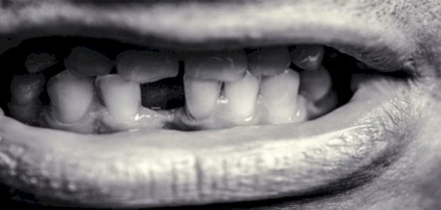 تفسير حلم الأسنان السوداء للمتزوجةترى المتزوجة في منامها الأسنان السوداء مما يدفعها إلى محاولة التعرف على تفسير هذه الرؤية الغريبة، حيث تكون غريبة