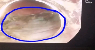 نجاح استئصال ورم سطحي بالقولون باستخدام تقنية مناظير الفراغ الثالث بمستشفيات قنا الجامعية قنا ممدوح السنبسي أعلنت مستشفيات قنا الجامعية عن نجاح أول عملية استئصال ورم سطحي كبير بالق