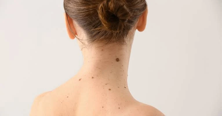 إذا كانت هذه العلامات في جسمك .. فأنت محظوظ.يعتقد البعض أن هناك بعض العلامات في الجسم تدل على الخير أو الحظ السعيد، حيث يتأثر الكثير من الأشخاص ببعض الأفكار القديمة المتوارثة عبر ا