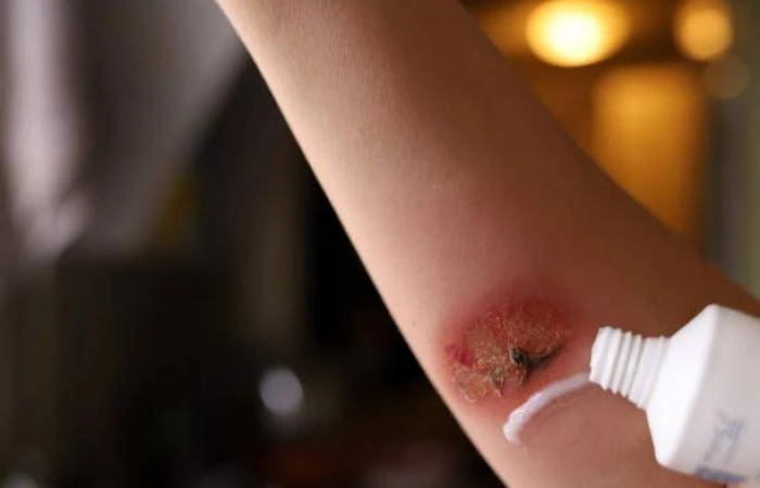 يدمر حرق من الدرجة الثالثة الطبقات الثلاثة الأولى من الجلد والأنسجة الدهنية، وقد لا يشعر الشخص الذي يعاني حرقا من الدرجة الثالثة بالألم على الفور، لكن سيلاحظ أن الجلد قد تفحم وأصبح