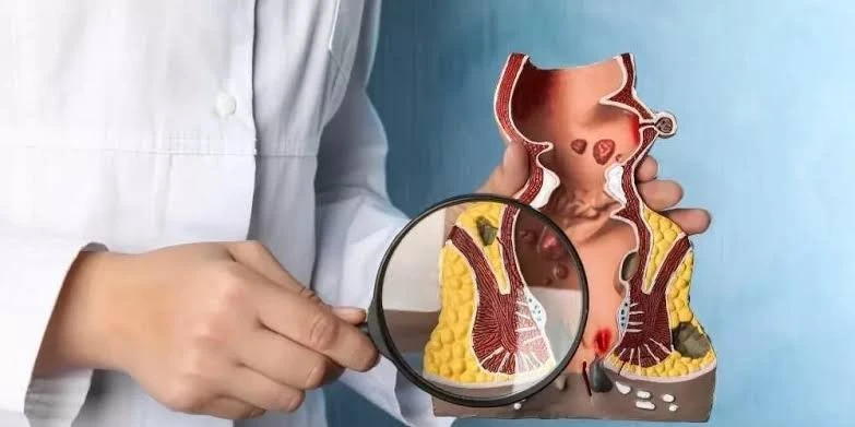 تناول الألياف وشرب الكثير من الماء .. أهم النصائح لمريض البواسير.يعانى مرضى البواسير من الألم أثناء التبرز، وفقا لتقرير نشر فى موقع أن البواسير نوعان داخلية وأخرى خارجية، من فتحة ا