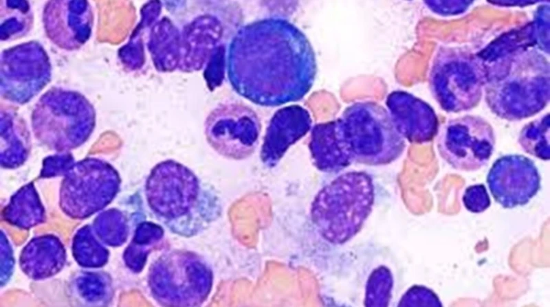 بعد اكتشاف أول حالة في مصر.. ما هو مرض المناعي؟ على هامش اختتام فعاليات المؤتمر السنوي لقسم الأمراض الصدرية بطب قصر العيني، كشف رئيس قسم الأمراض الصدرية يسري عقل، اكتشاف أول حالة م