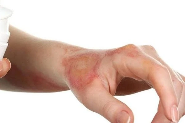 تعرف على أنواع وطرق علاج الحروق.هناك أربعة أنواع من الحروق، الدرجة الأولي والثانية والثالثة والرابعة، والفرق بينهم هو:حروق الدرجة الأولييطلق عليها الحروق السطحية، وتعد خفيفة مقارنة