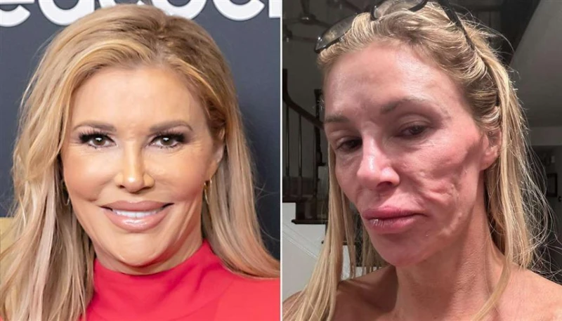 نجمة أميركية شهيرة تكشف عن بكتيريا شوهت وجهها افاق عربية - أثارت نجمة تلفزيون واقع أمريكية ضجة كبيرة بعد مشاركة قصة معاناتها مع طفيلي مجهول محتمل