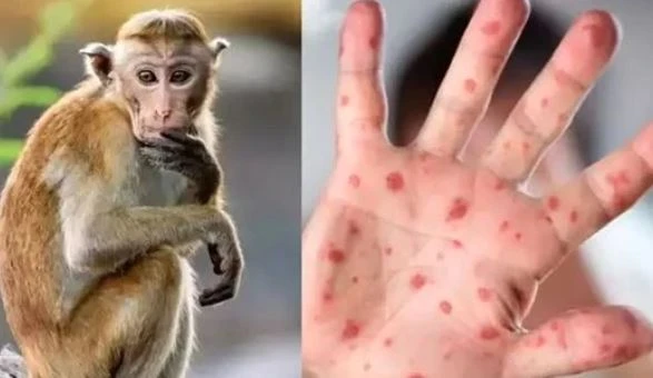 استشاري أمراض معدية: جدري القردة له لقاح وعلاج قال استشاري الأمراض المعدية الدكتور عبد الله عسيري، إن جدري القردة يشكل خطرا على الصحة العامة في الدول الأخرى، ويتطلب استجابة دولية م