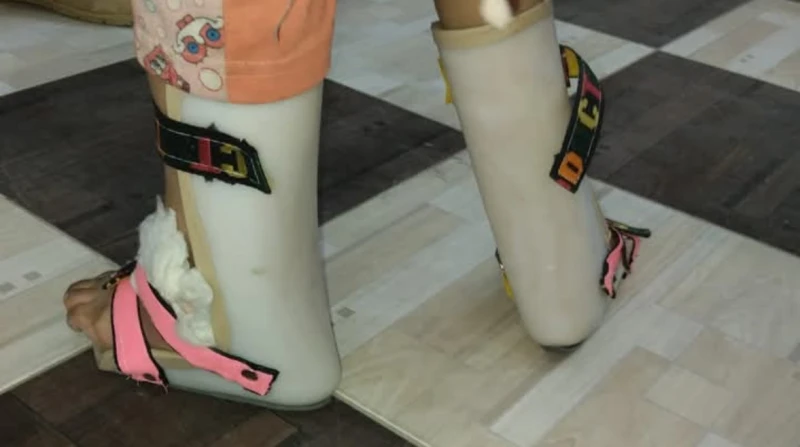 البتر أو فقدان حياتها.. أسرة جنا تستغيث لقطع قدم ابنتها بعد إصابتها ب سوسة العظام استغاثت أسرة الطفلة جنا، بالمسؤولين في وزارة الصحة، سرعة إنقاذها والتدخل الجراحي لبتر قدمها بعد تد