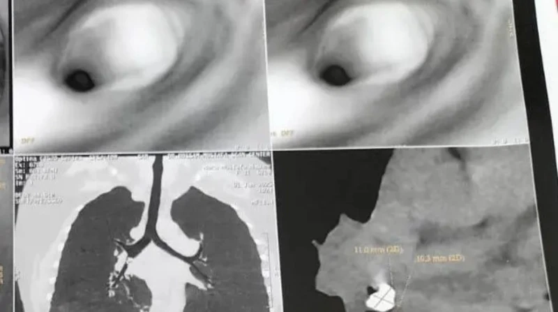 جامعي أسيوط ينجح في إخراج ضرس من رئة مريضة تمكن فريق طبي بمستشفى القلب بجامعة أسيوط، من إجراء عملية جراحية دقيقة لاستخراج جسم متليف من الشعب الهوائية لمريضة، مع الحفاظ على حالة الر