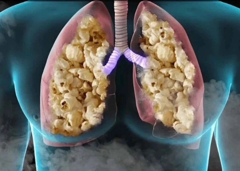 رئة الفشار.. مرض صامت يهدد حياتك دون أن تدري عاد مرض رئة الفشار ليتصدر عناوين التحذيرات الطبية حول العالم، بعد تزايد حالات الإصابة بهذا المرض التنفسي النادر، والذي يعرف علميا بالته