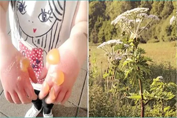 احذر الهوجويد.. نبتة قاتلة تنتشر في المملكة المتحدة وتحدث أضرارا بالغة في الجلد دق خبراء البيئة في المملكة المتحدة ناقوس الخطر مؤخرا، محذرين من