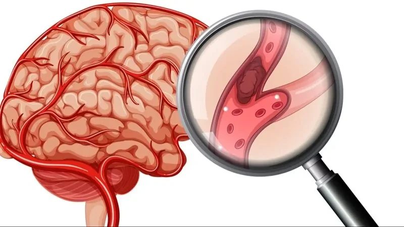 احذر.. إشارات خفية في عينيك قد تنذر بجلطة خطيرة تهدد بصرك! في خضم انشغالات الحياة اليومية، قد لا نلتفت إلى بعض العلامات الدقيقة التي يرسلها لنا الجسم، رغم أنها قد تكون إنذارا مبكرا