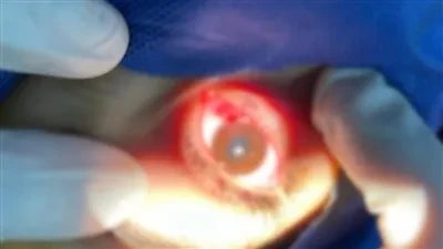 مستشفى الزقازيق لعلاج العيون يحقق نجاحًا في إنقاذ طفل من إصابة بانفجار في عينه