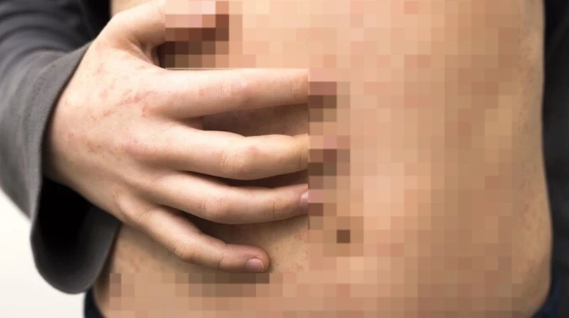 1880 إصابة، مرض جلدي ينتشر سريعًا في إسرائيل