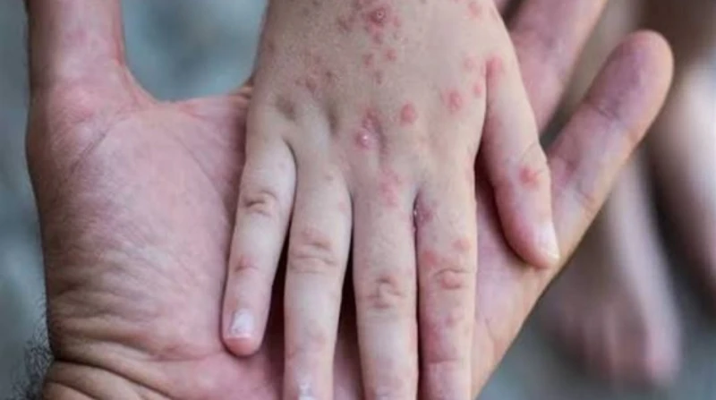 بعد ظهوره بين طلاب مدارس، كل ما تريد معرفته عن الجدري المائي