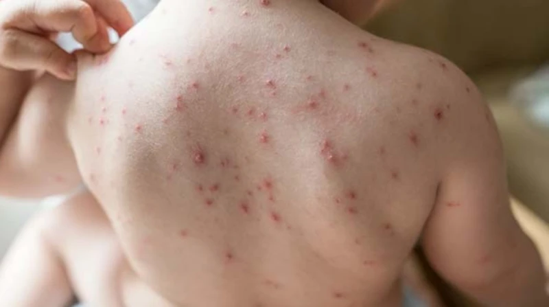 بعد إصابات المنوفية، ما هو مرض الجدري المائي وأعراضه؟
