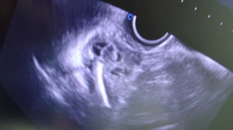 ضحية تركيب "لولب" تروي معاناتها وتتهم طبيبة بالإهمال (خاص)