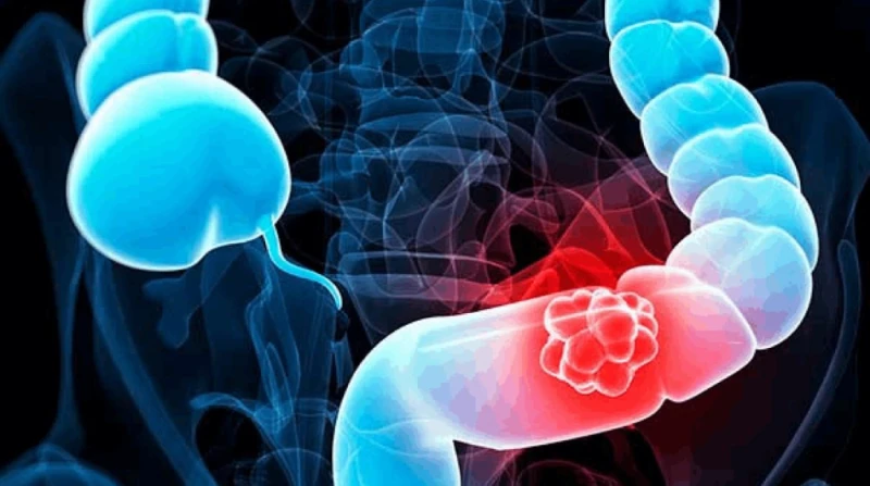 4 فواكه تقلل من خطر الإصابة بسرطان القولون