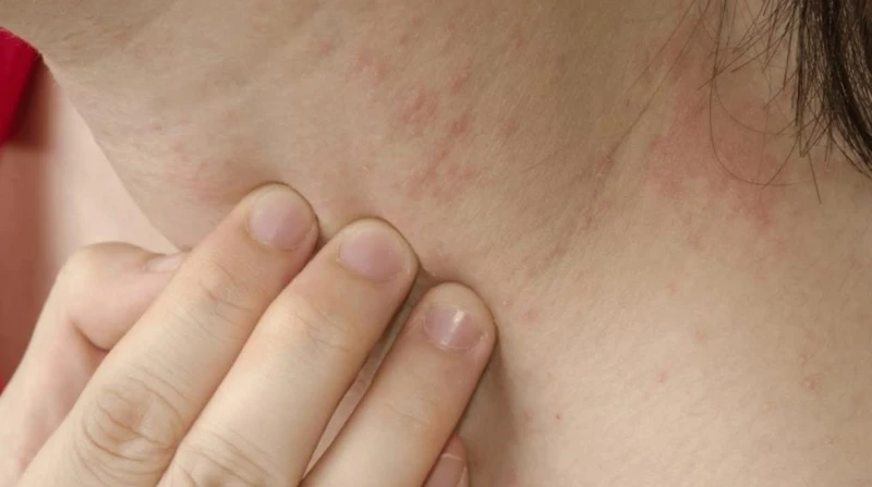 مرض جلدي "شديد العدوى" من العصور الوسطى ينتشر في بريطانيا