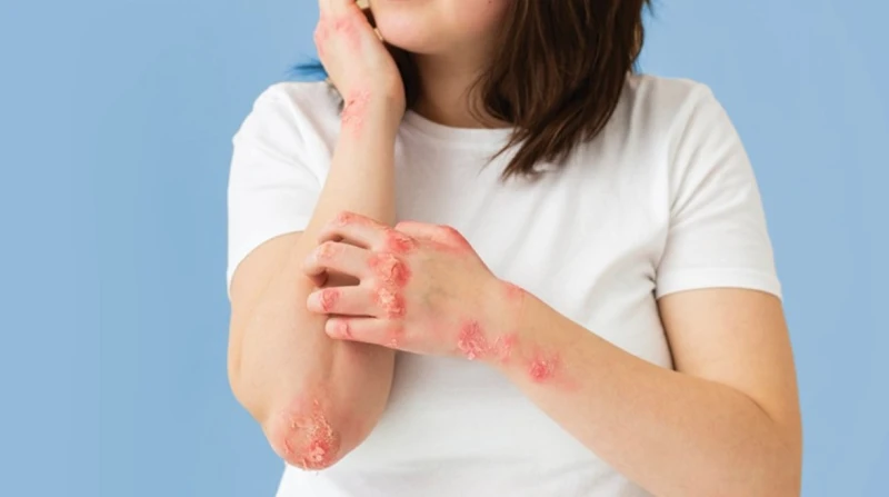 جفاف الشتاء يهدد الجلد، تحذيرات للأشخاص المصابين بالأكزيما والصدفية