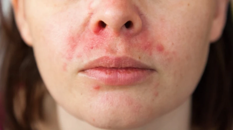 تكثر في الشتاء، 5 وصفات طبيعية لعلاج التهاب الجلد حول الفم
