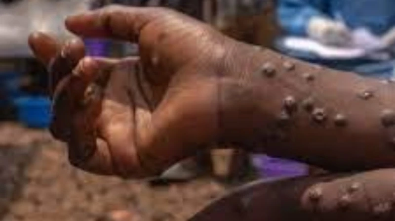 جدري القرود يتسبب في وفاة 17 حالة بأفريقيا خلال أسابيع