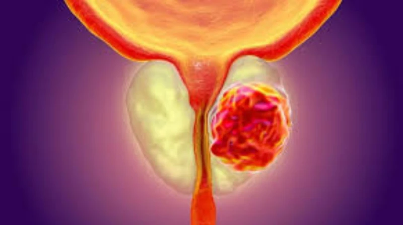 دراسة: الذكاء الاصطناعي تحت الاختبار لاتخاذ قرارات بشأن أورام البروستاتا