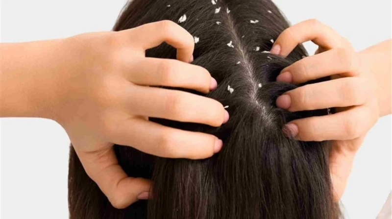 كيف تسبب مياه الاستحمام قشرة الشعر وطرق علاجها؟.. استشاري جلدية يوضح