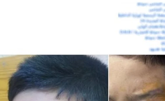 مدرس في دمياط فتح حاجب طالب بعصا خشبيه : ليه كدة يا استاذ