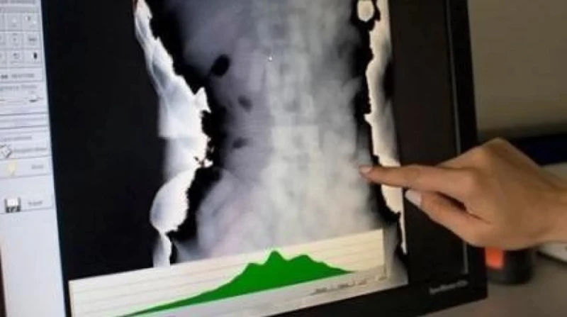 الكويت تحبط محاولة تهريب حشيش في أمعاء مسافر أجنبي