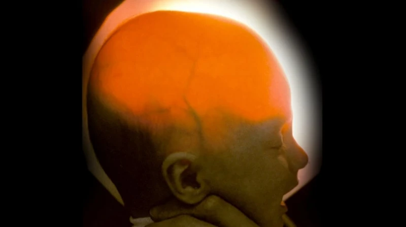 حالة نادرة تتحدى الطب، فتاة تحتفل بمرور 20 عامًا على ولادتها دون مخ