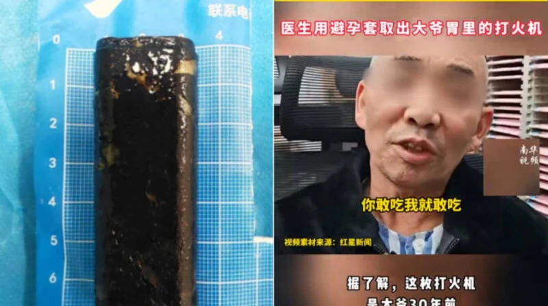 تحتفظ بالغاز وتعمل، صيني ينسى ولاعة في معدته 30 عامًا