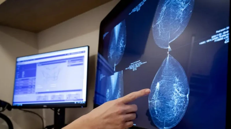 الذكاء الاصطناعي يكشف سرطان الثدي في مراحله الخفية