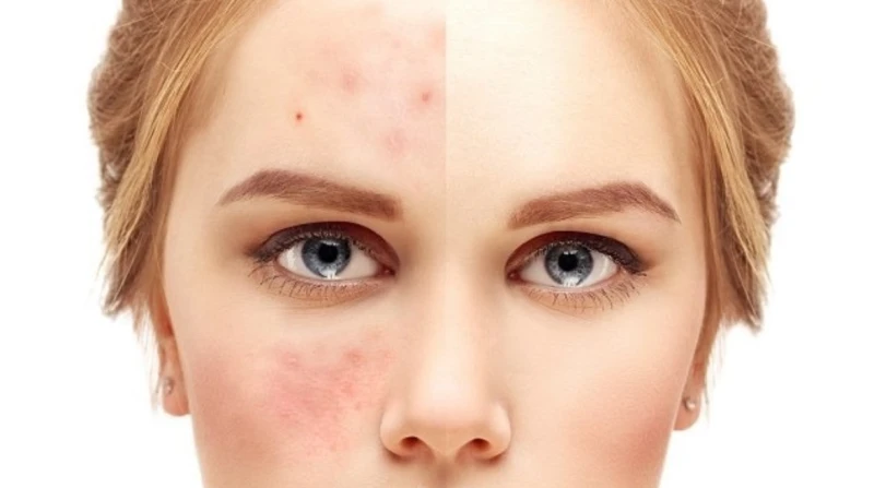 طرق فعالة لمكافحة حب الشباب وجفاف البشرة وبهتانها في الشتاء