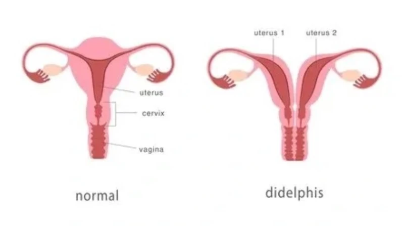 حالة طبية نادرة، صدفة تقود عشرينية لاكتشاف إصابتها بـ الرحم المزدوج