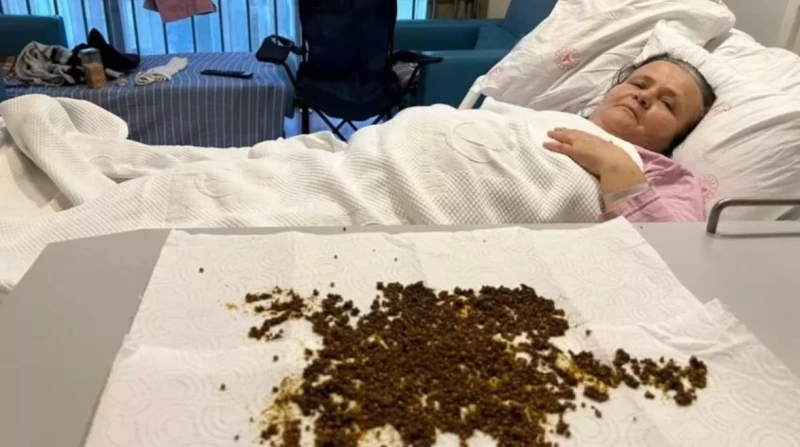 حالة نادرة، استخراج 20 ألف حصوة من مرارة سيدة تركية