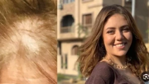 تطورات حالة رحمة حسن الصحية: اصيبت بمرض الصلع