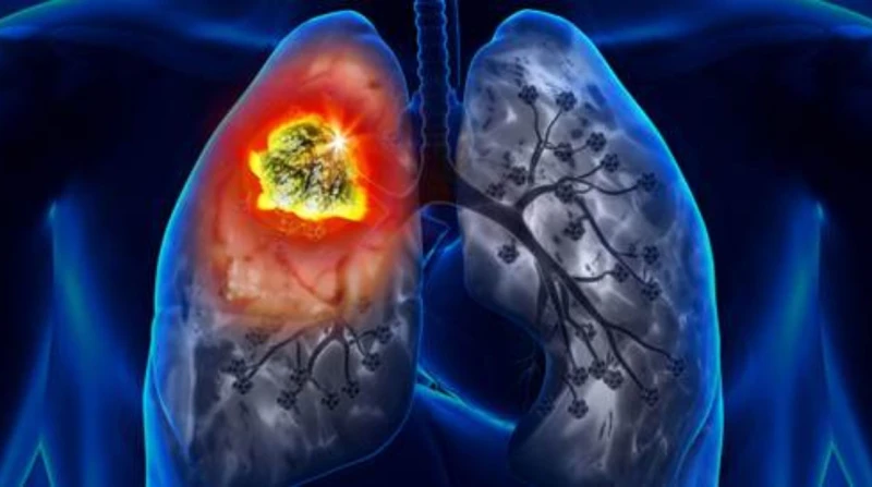 الكشف المبكر ينقذ الأرواح، 6 أعراض شائعة لسرطان الرئة