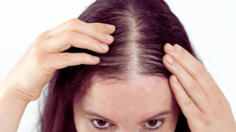 بخلاف العوامل الوراثية, 5 فيتامينات مهمة تحمي "تاج رأسك"