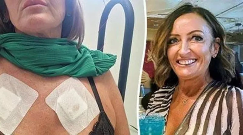 حمالة صدر تسبب حروقًا وبثورًا لسيدة بريطانية وتتركها مع ندوب دائمة
