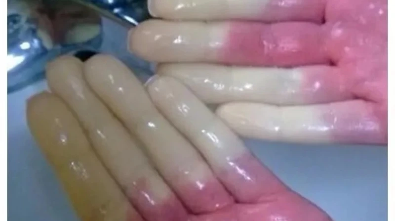 تغيير لون الأصابع في الشتاء, ما هي ظاهرة رينود؟