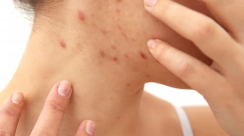 استعيدي ثقتك بنفسك، 5 نصائح لعلاج حب الشباب المرتبط بـ تكيس المبايض