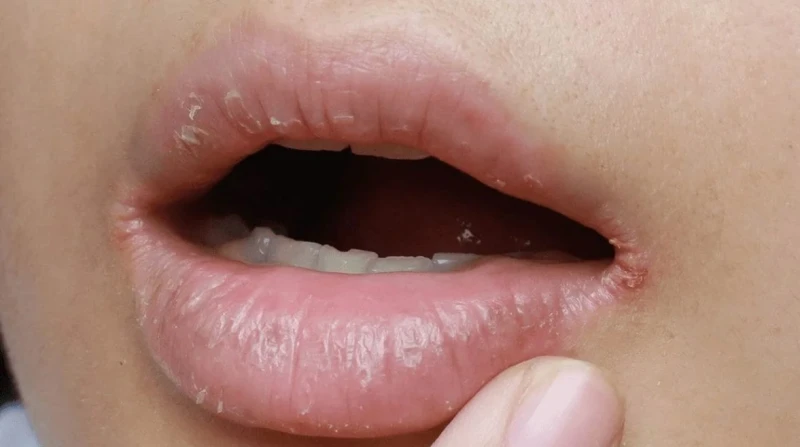 ليس الترطيب فحسب، أسباب تشقق الشفاه المزمن وطرق العلاج