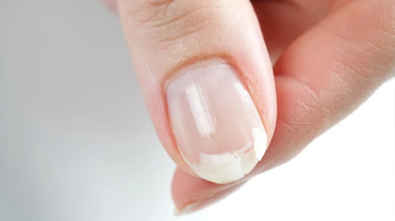 لا تتجاهلها، 5 علامات على الأظافر تُنذر بمشاكل صحية خطيرة