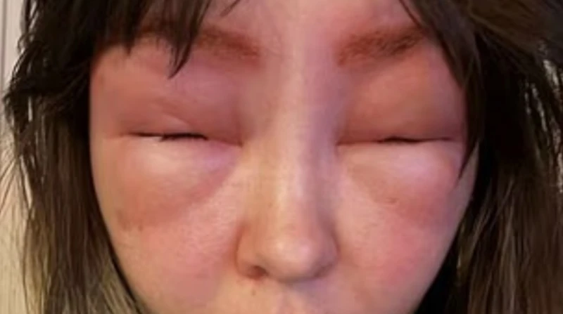 فقدت البصر مؤقتا، كندية تصاب بحساسية مروعة بسبب صبغة الحواجب