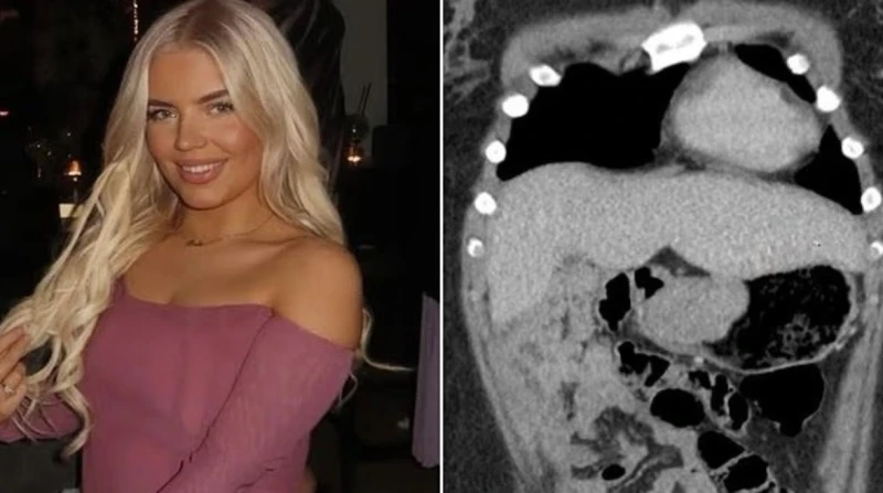 الأطباء شخصوها بـ مشاكل نسائية، فتاة تفقد 70% من معدتها بسبب سرطان نادر