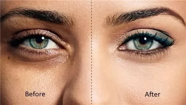 3 علاجات طبيعية للتخلص من الهالات السوداء تحت العينين بفاعلية وأمان