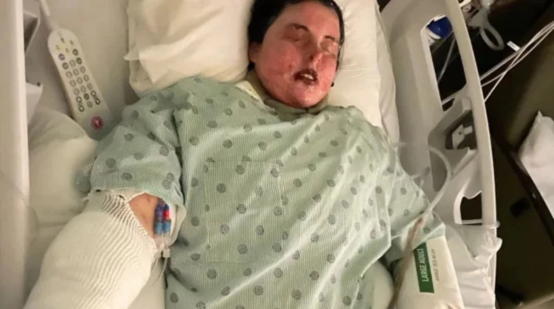 فقدت بصرها وجلدها، متلازمة نادرة تحول حياة سيدة أمريكية إلى جحيم