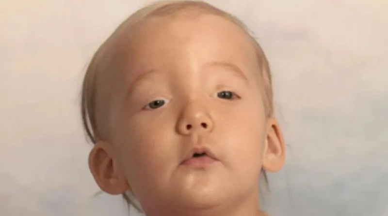 متلازمة تدلي الجفون.. فيديو سابرينا يشعل "تيك توك" ويكشف أعراضها