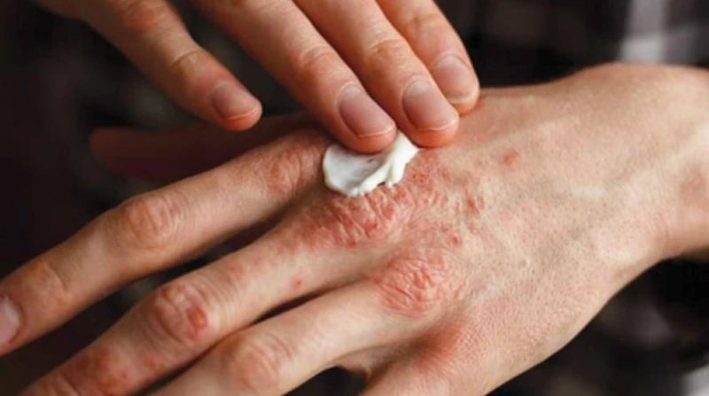 إكزيما الشتاء.. أسبابها وطرق الوقاية