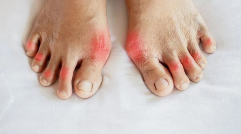 الروماتويد في الشتاء، كيف تحمي المفاصل من الآلام اليومية؟